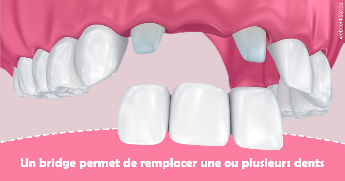 https://selarl-dr-robbiani-eric.chirurgiens-dentistes.fr/Bridge remplacer dents 2