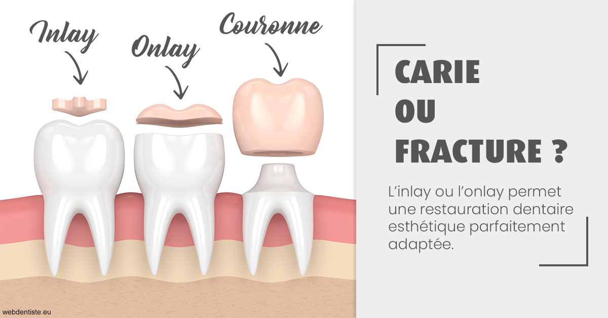 https://selarl-dr-robbiani-eric.chirurgiens-dentistes.fr/T2 2023 - Carie ou fracture 1