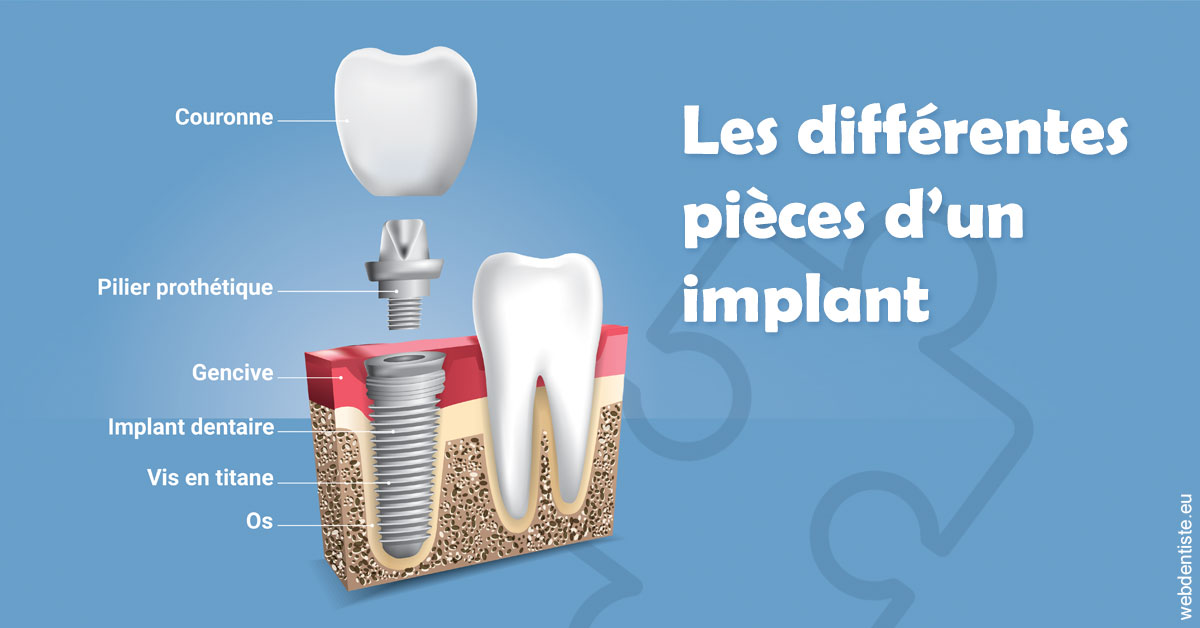 https://selarl-dr-robbiani-eric.chirurgiens-dentistes.fr/Les différentes pièces d’un implant 1